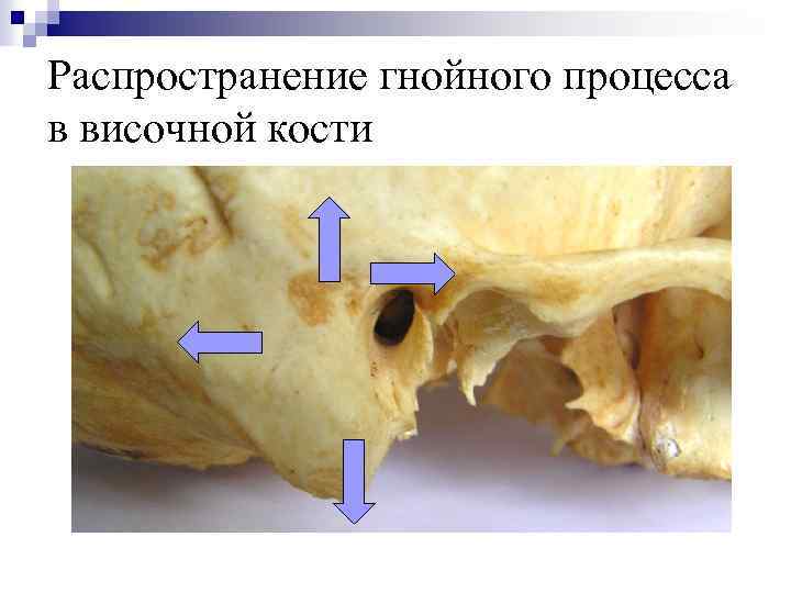 Распространение гнойного процесса в височной кости 