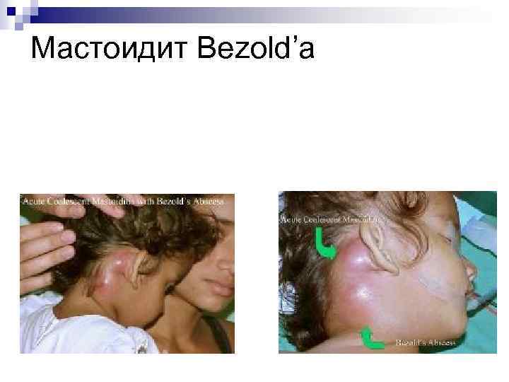 Мастоидит Bezold’a 