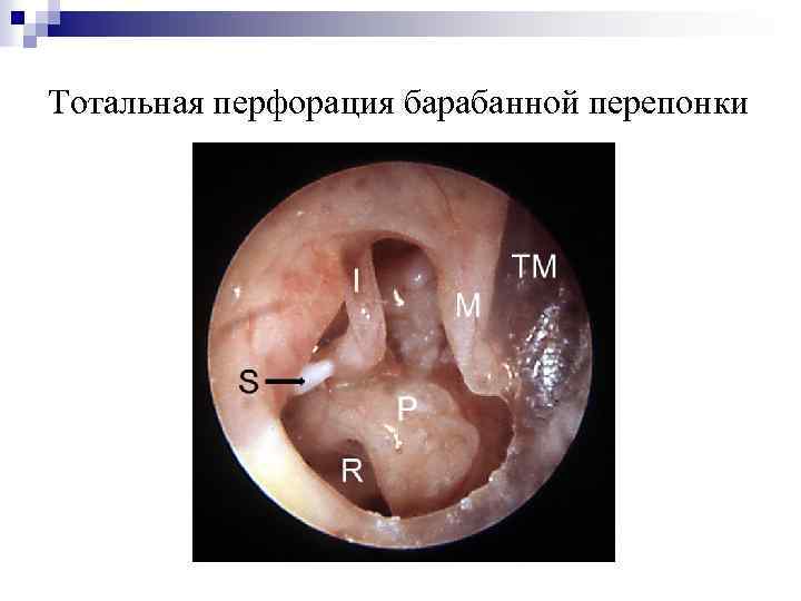 Тотальная перфорация барабанной перепонки 