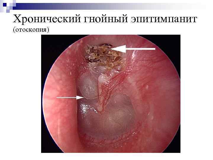 Хронический гнойный эпитимпанит (отоскопия) 