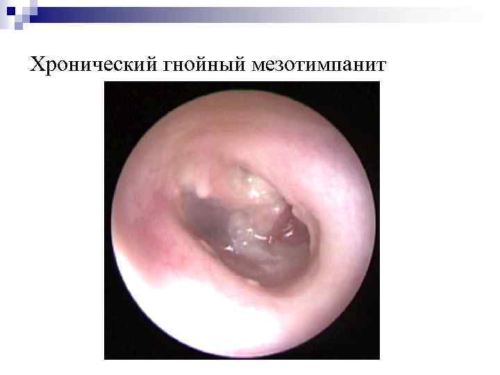 Хронический гнойный мезотимпанит 