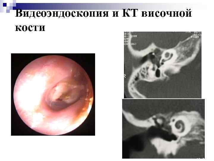 Видеоэндоскопия и КТ височной кости 