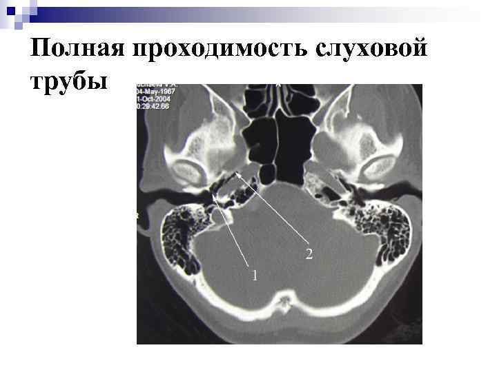 Полная проходимость слуховой трубы 