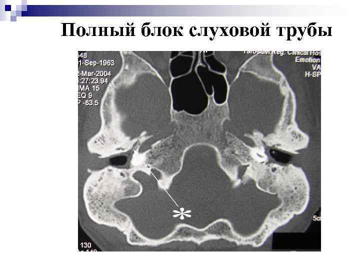 Полный блок слуховой трубы 