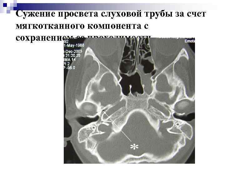 Сужение просвета слуховой трубы за счет мягкотканного компонента с сохранением ее проходимости 