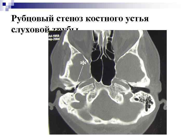 Рубцовый стеноз костного устья слуховой трубы 