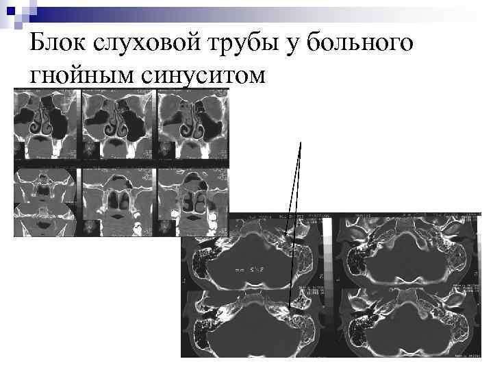 Блок слуховой трубы у больного гнойным синуситом 