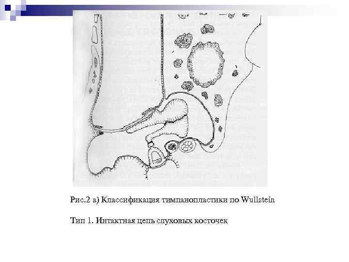 Рис. 2 а) Классификация тимпанопластики по Wullstein Тип 1. Интактная цепь слуховых косточек 