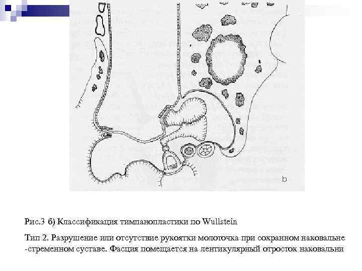 Рис. 3 б) Классификация тимпанопластики по Wullstein Тип 2. Разрушение или отсутствие рукоятки молоточка