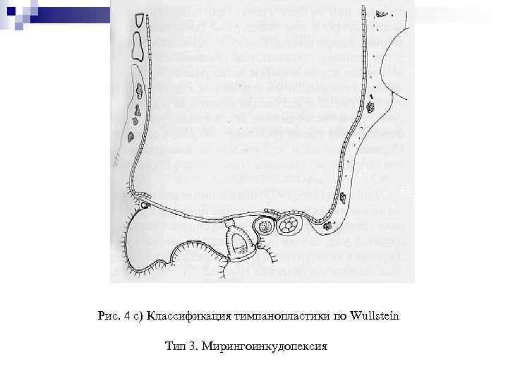 Рис. 4 с) Классификация тимпанопластики по Wullstein Тип 3. Мирингоинкудопексия 