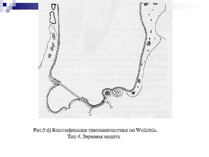 Рис. 5 d) Классификация тимпанопластики по Wullstein. Тип 4. Звуковая защита 