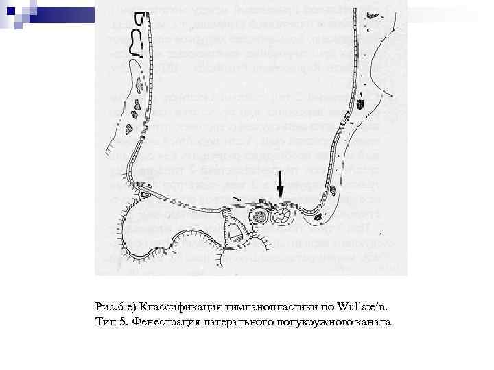 Рис. 6 e) Классификация тимпанопластики по Wullstein. Тип 5. Фенестрация латерального полукружного канала 