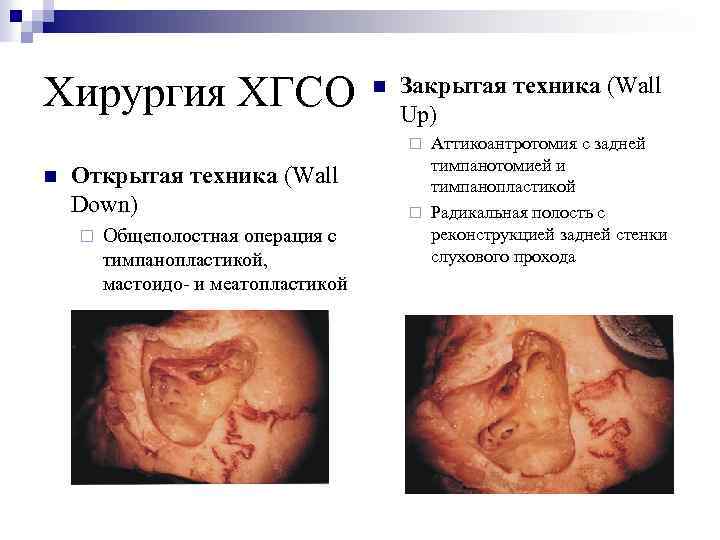 Хирургия ХГСО n Закрытая техника (Wall Up) Аттикоантротомия с задней тимпанотомией и тимпанопластикой ¨