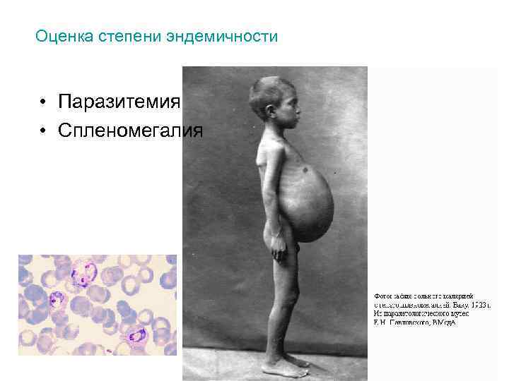 Оценка степени эндемичности • Паразитемия • Спленомегалия 