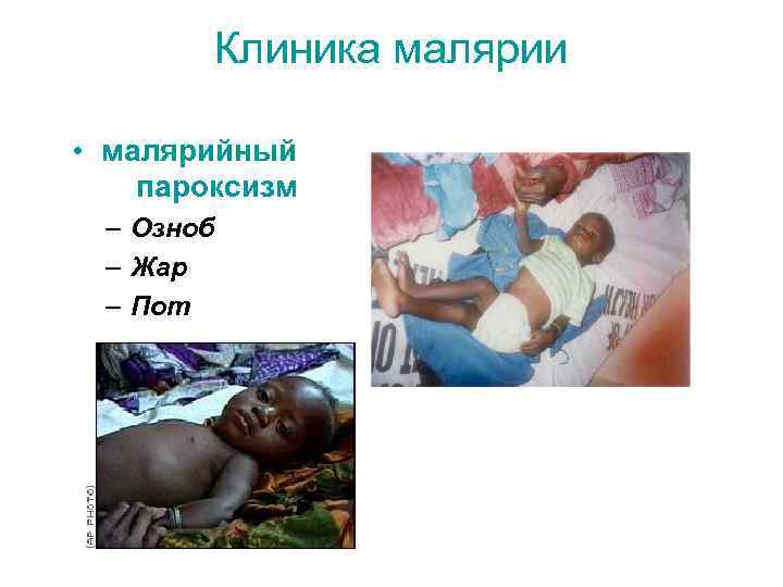 Клиника малярии • малярийный пароксизм – Озноб – Жар – Пот 