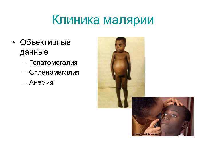 Клиника малярии • Объективные данные – Гепатомегалия – Спленомегалия – Анемия 