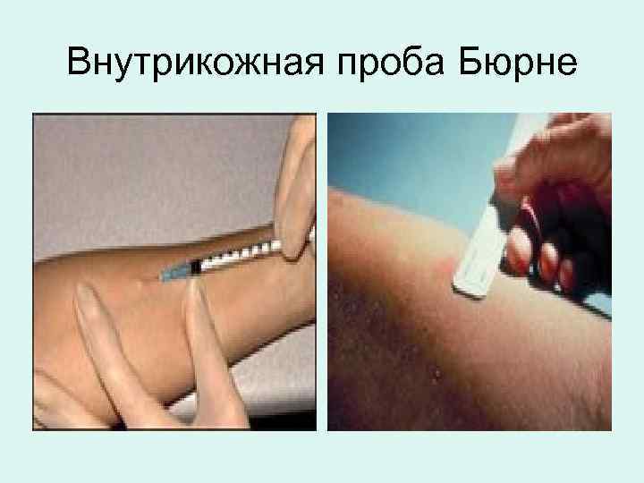 Внутрикожная проба Бюрне 