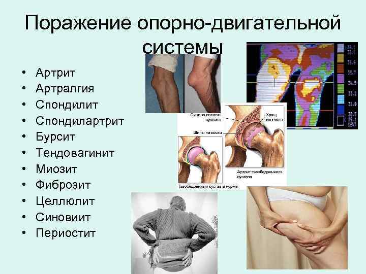 Поражение опорно-двигательной системы • • • Артрит Артралгия Спондилит Спондилартрит Бурсит Тендовагинит Миозит Фиброзит