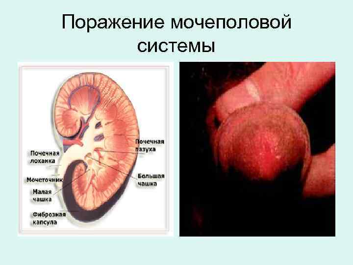 Поражение мочеполовой системы 