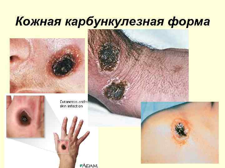 Кожная карбункулезная форма 