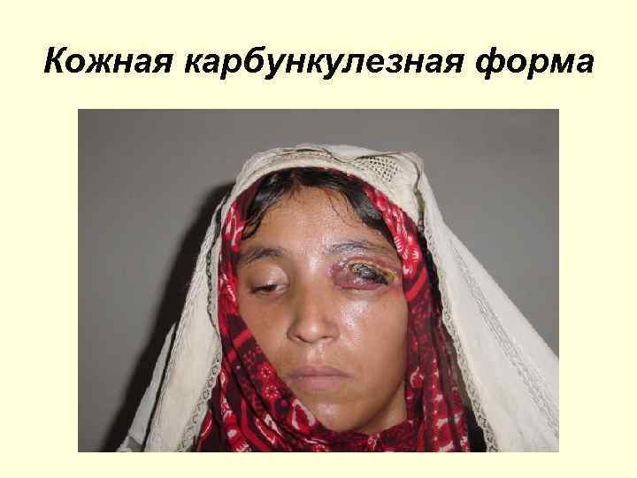 Кожная карбункулезная форма 