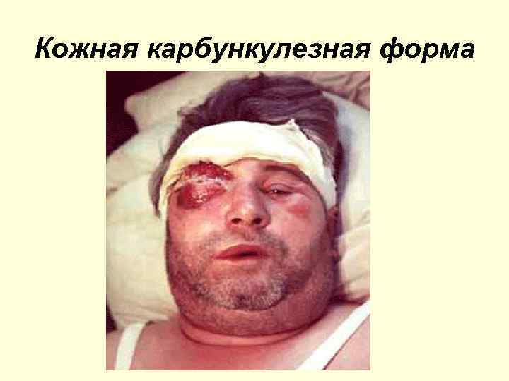 Кожная карбункулезная форма 