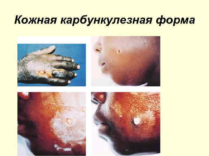 Кожная карбункулезная форма 