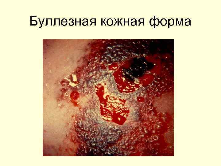 Буллезная кожная форма 