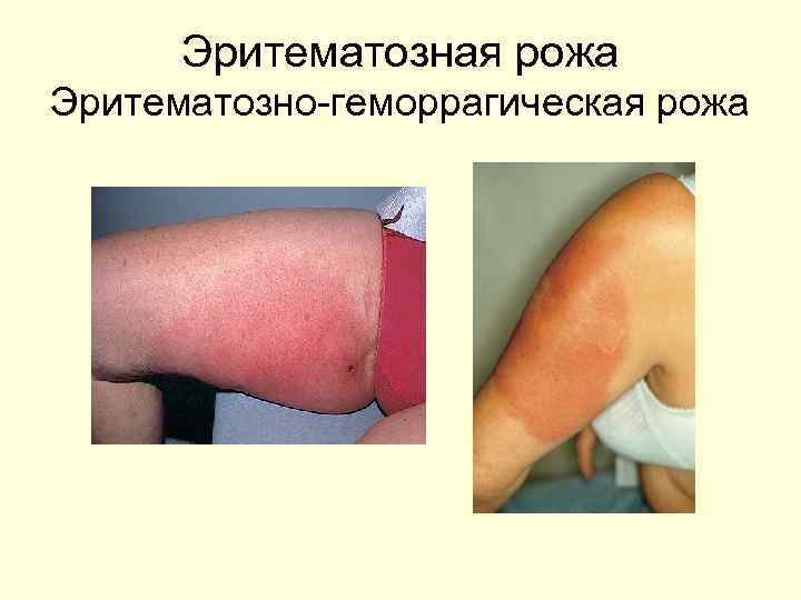 Эритематозная рожа Эритематозно-геморрагическая рожа 