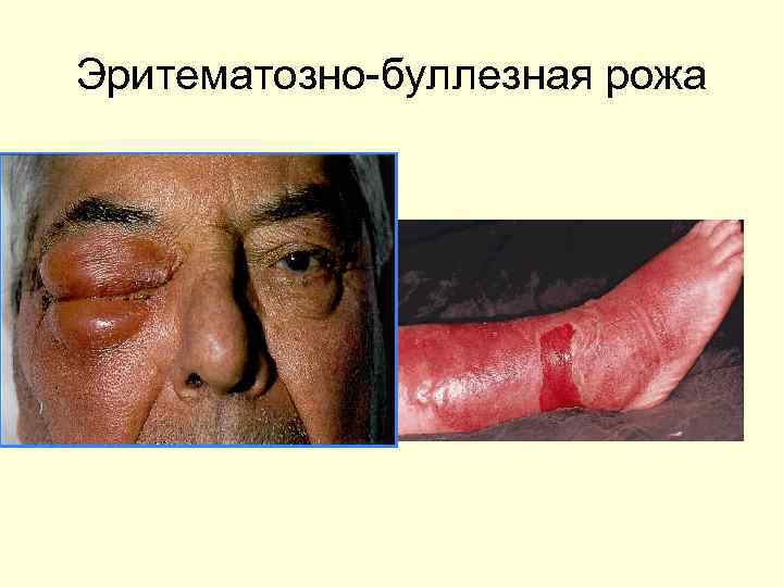 Эритематозно-буллезная рожа 