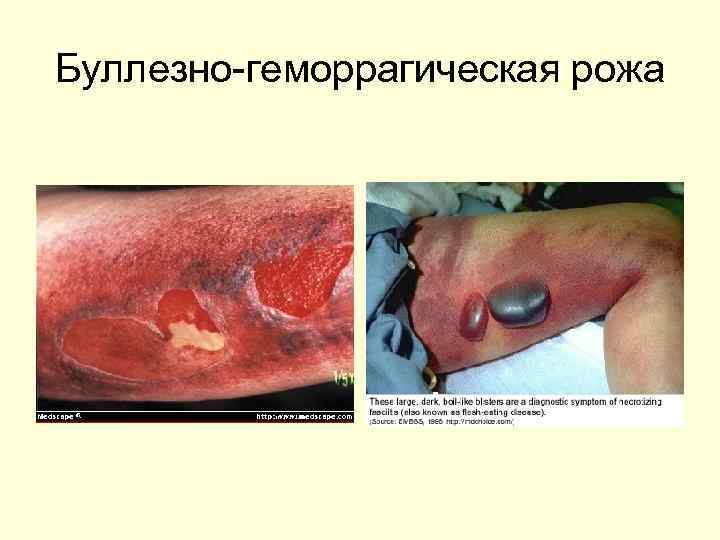 Буллезно-геморрагическая рожа 