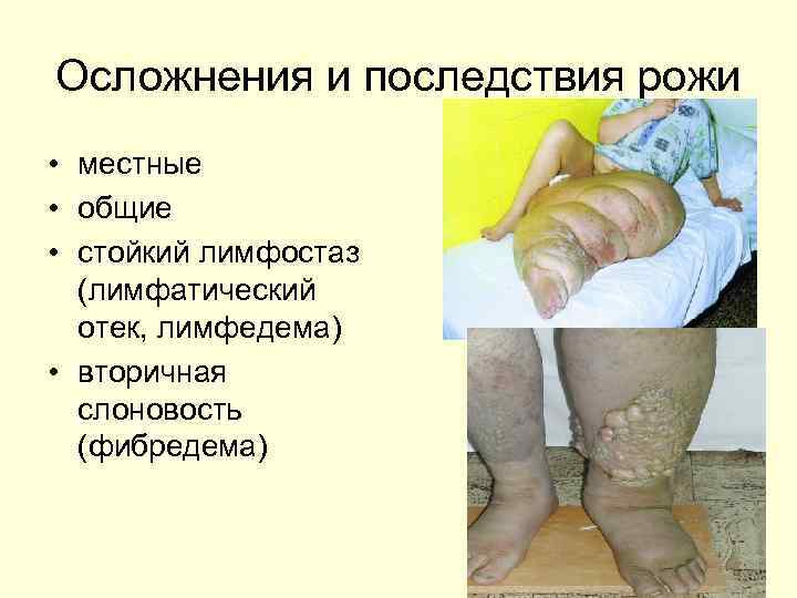 Осложнения и последствия рожи • местные • общие • стойкий лимфостаз (лимфатический отек, лимфедема)