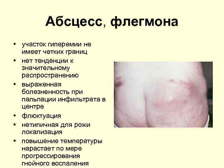 Абсцесс, флегмона • участок гиперемии не имеет четких границ • нет тенденции к значительному