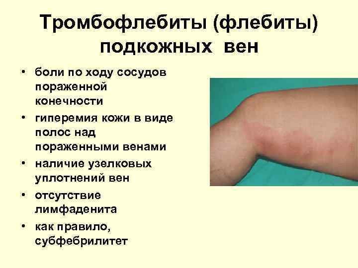Тромбофлебиты (флебиты) подкожных вен • боли по ходу сосудов пораженной конечности • гиперемия кожи