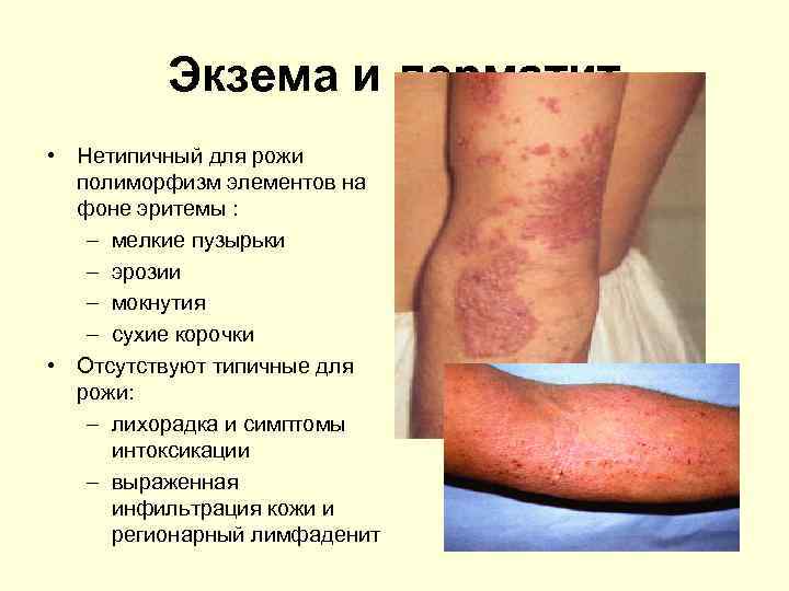 Экзема и дерматит • Нетипичный для рожи полиморфизм элементов на фоне эритемы : –