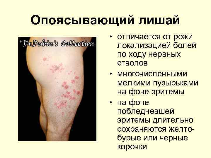 Опоясывающий лишай • отличается от рожи локализацией болей по ходу нервных стволов • многочисленными