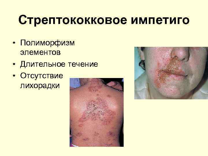 Стрептококковое импетиго • Полиморфизм элементов • Длительное течение • Отсутствие лихорадки 