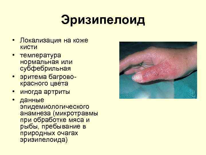 Эризипелоид • Локализация на коже кисти • температура нормальная или субфебрильная • эритема багровокрасного