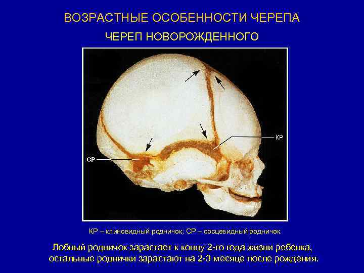 Возрастная анатомия черепа. Сосцевидный Родничок черепа. Клиновидный Родничок черепа. Череп новорожденного возрастные особенности черепа. Клиновидный и сосцевидный роднички.