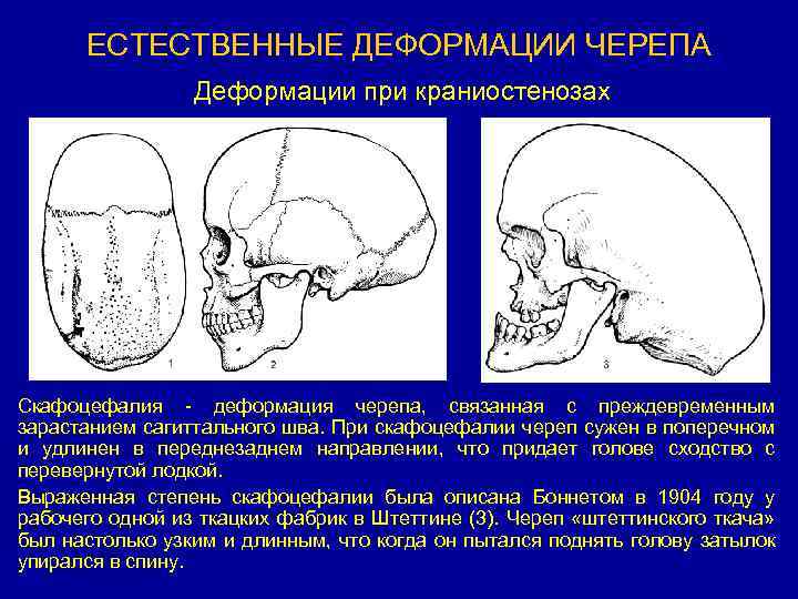 Наушники деформируют череп