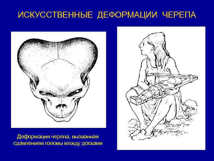 Наушники деформируют череп