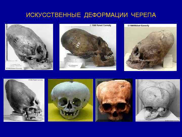 ИСКУССТВЕННЫЕ ДЕФОРМАЦИИ ЧЕРЕПА 