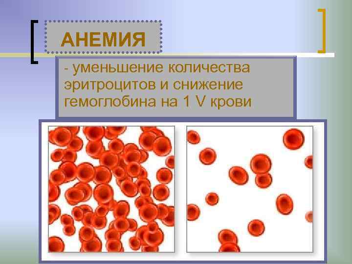 АНЕМИЯ - уменьшение количества эритроцитов и снижение гемоглобина на 1 V крови 