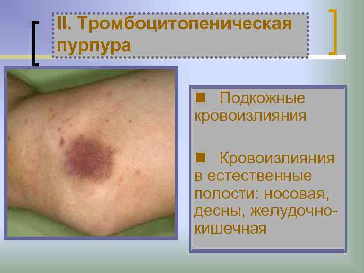 II. Тромбоцитопеническая пурпура n Подкожные кровоизлияния n Кровоизлияния в естественные полости: носовая, десны, желудочнокишечная