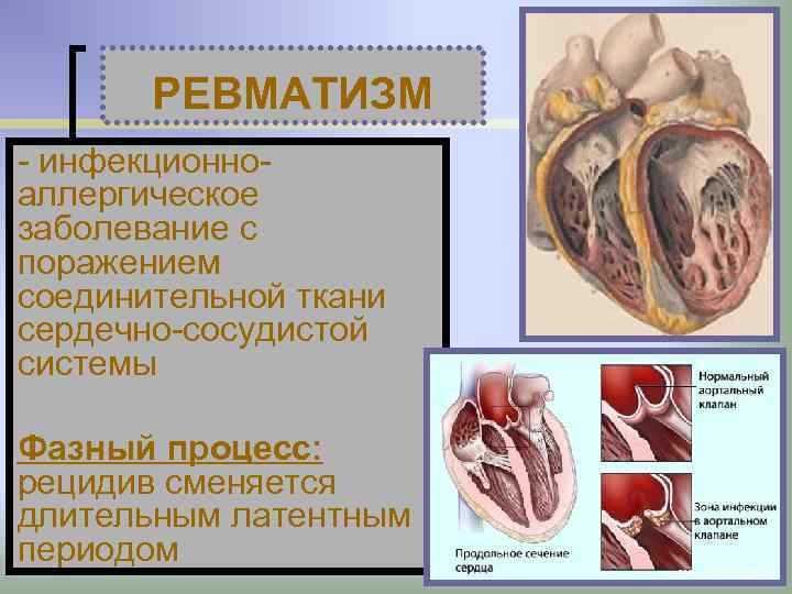 РЕВМАТИЗМ - инфекционноаллергическое заболевание с поражением соединительной ткани сердечно-сосудистой системы Фазный процесс: рецидив сменяется