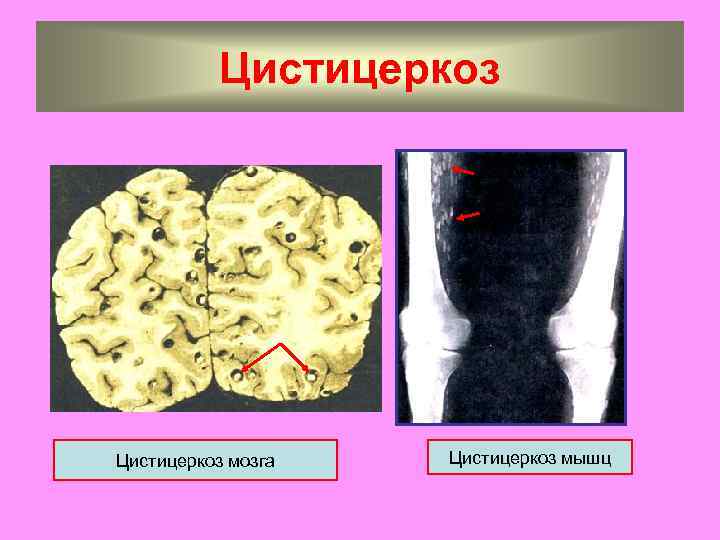 Цистицеркоз мозга Цистицеркоз мышц 