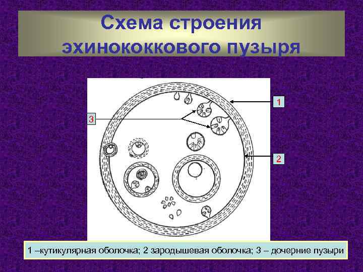 Схема строения эхинококкового пузыря 1 3 2 1 –кутикулярная оболочка; 2 зародышевая оболочка; 3