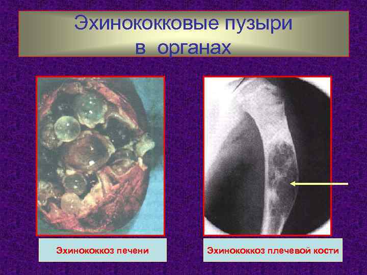 Эхинококковые пузыри в органах Эхинококкоз печени Эхинококкоз плечевой кости 