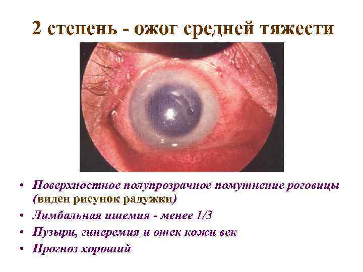 2 степень - ожог средней тяжести • Поверхностное полупрозрачное помутнение роговицы (виден рисунок радужки)
