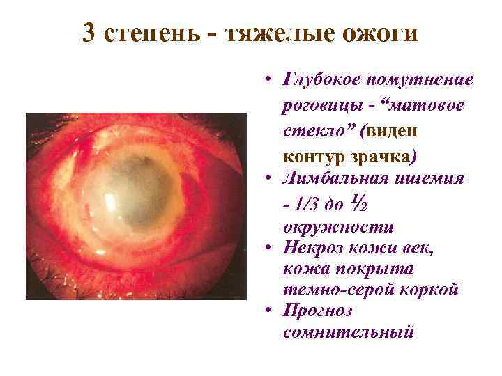 3 степень - тяжелые ожоги • Глубокое помутнение роговицы - “матовое стекло” (виден контур